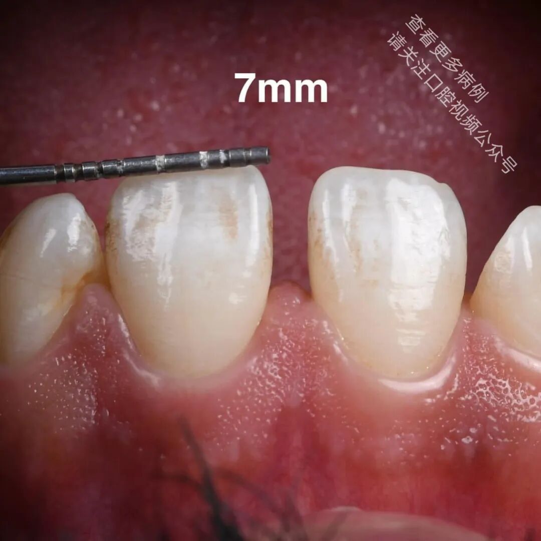 使用GC复合树脂关闭牙间隙，这16张图片讲清楚了