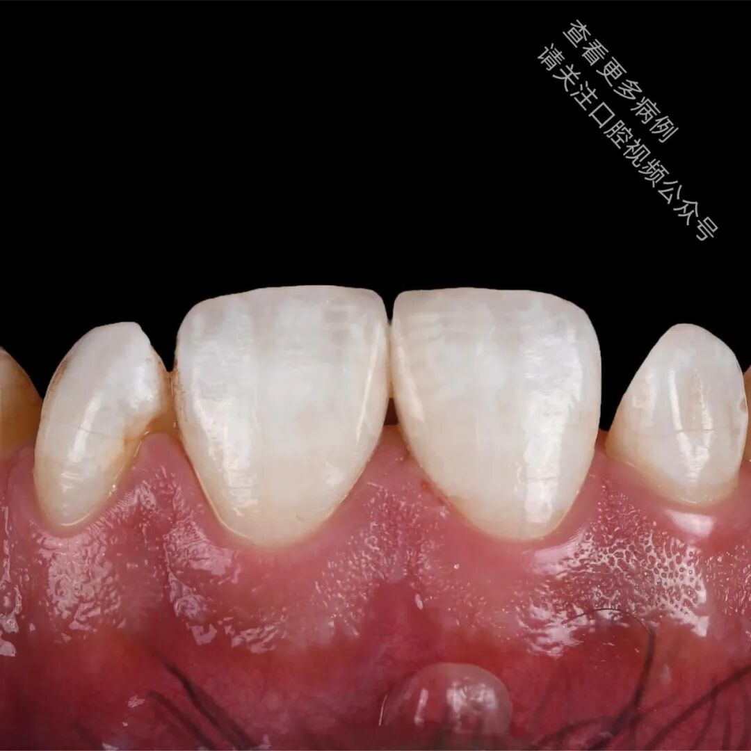 使用GC复合树脂关闭牙间隙，这16张图片讲清楚了