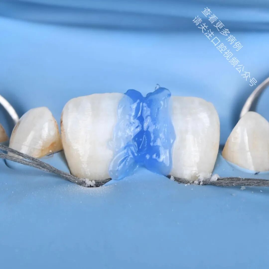 使用GC复合树脂关闭牙间隙，这16张图片讲清楚了