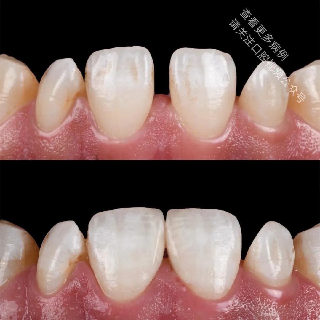 使用GC复合树脂关闭牙间隙，这16张图片讲清楚了