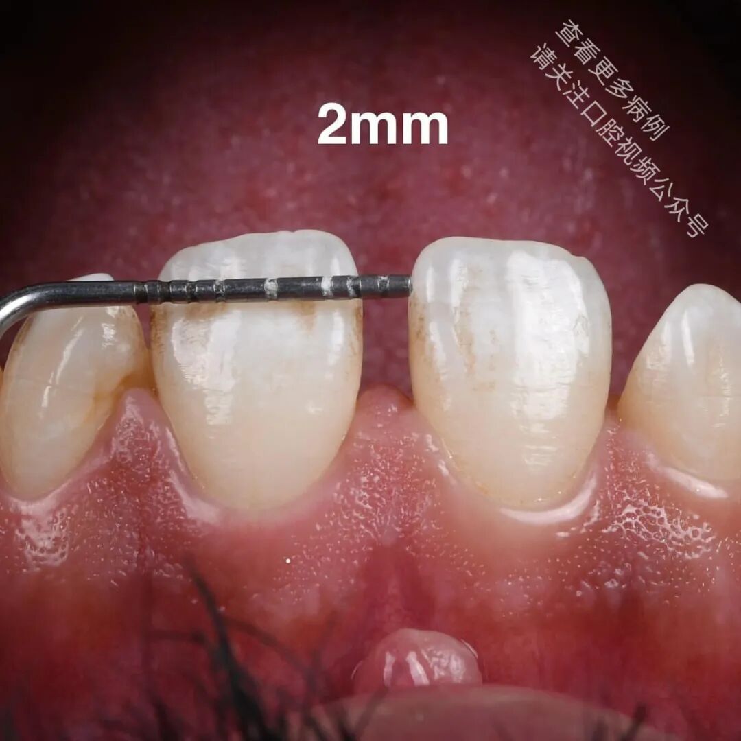 使用GC复合树脂关闭牙间隙，这16张图片讲清楚了