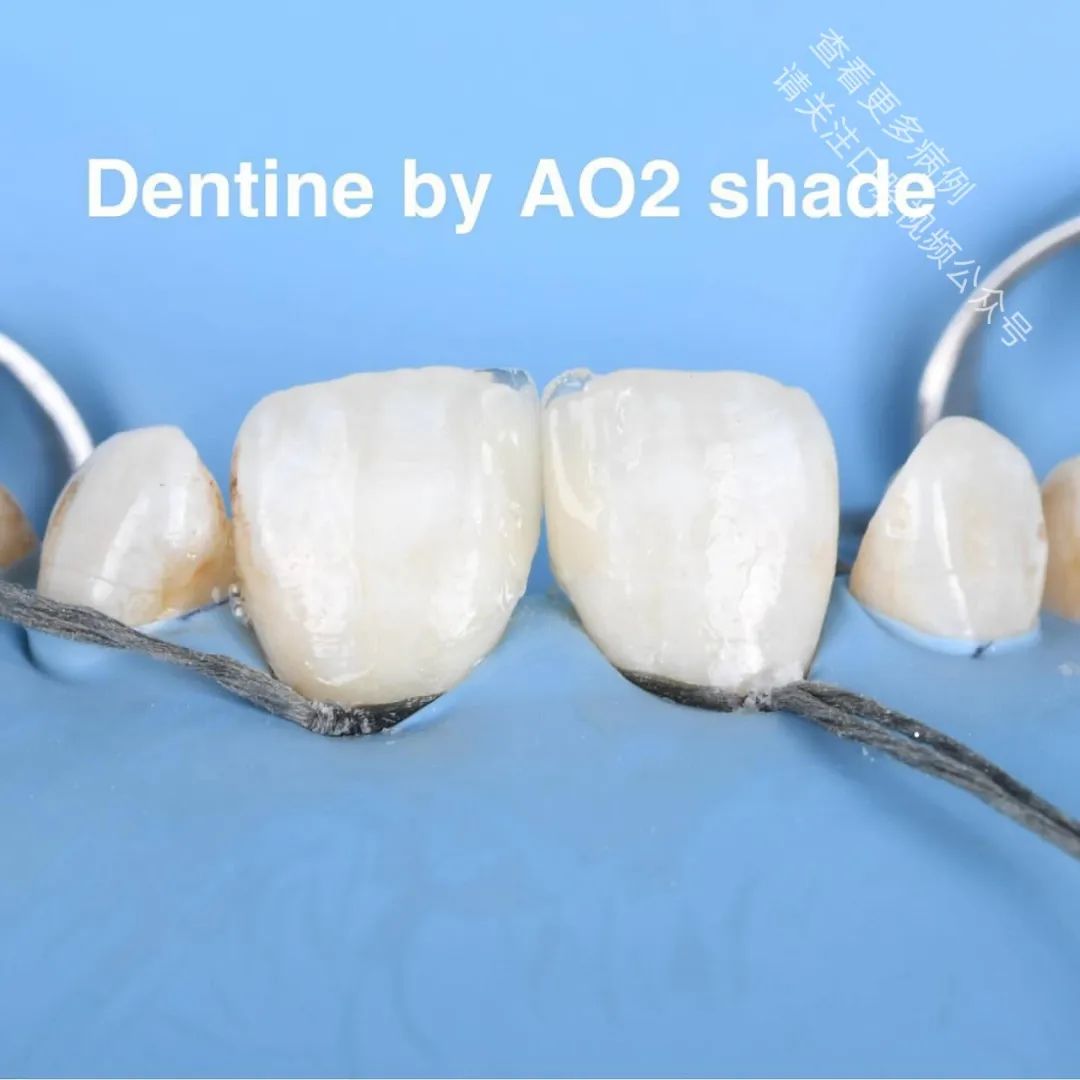 使用GC复合树脂关闭牙间隙，这16张图片讲清楚了