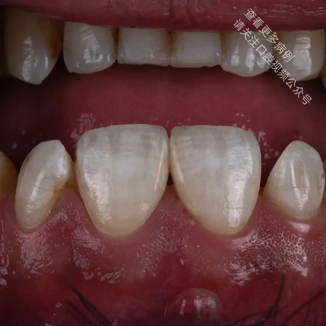 使用GC复合树脂关闭牙间隙，这16张图片讲清楚了