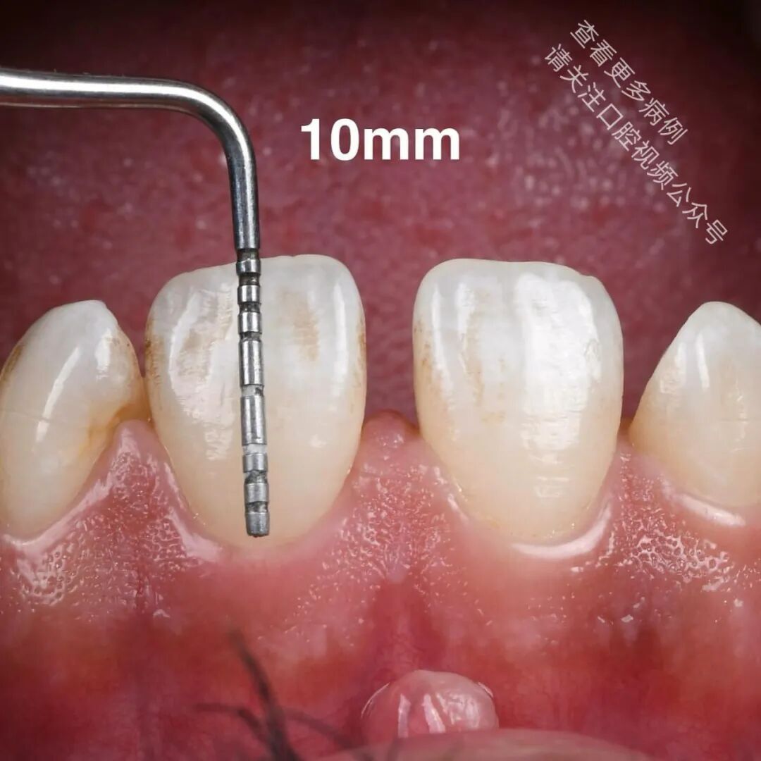 使用GC复合树脂关闭牙间隙，这16张图片讲清楚了
