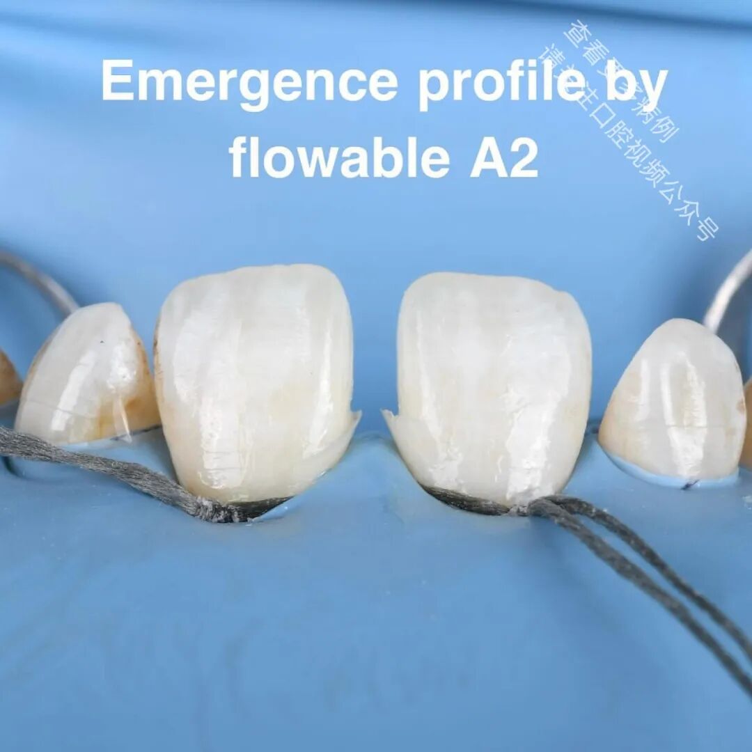 使用GC复合树脂关闭牙间隙，这16张图片讲清楚了