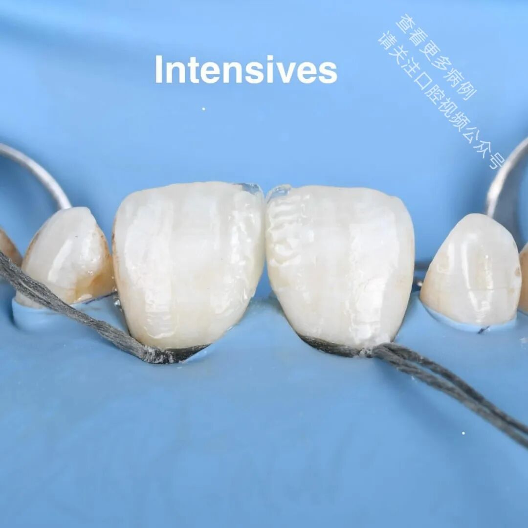 使用GC复合树脂关闭牙间隙，这16张图片讲清楚了