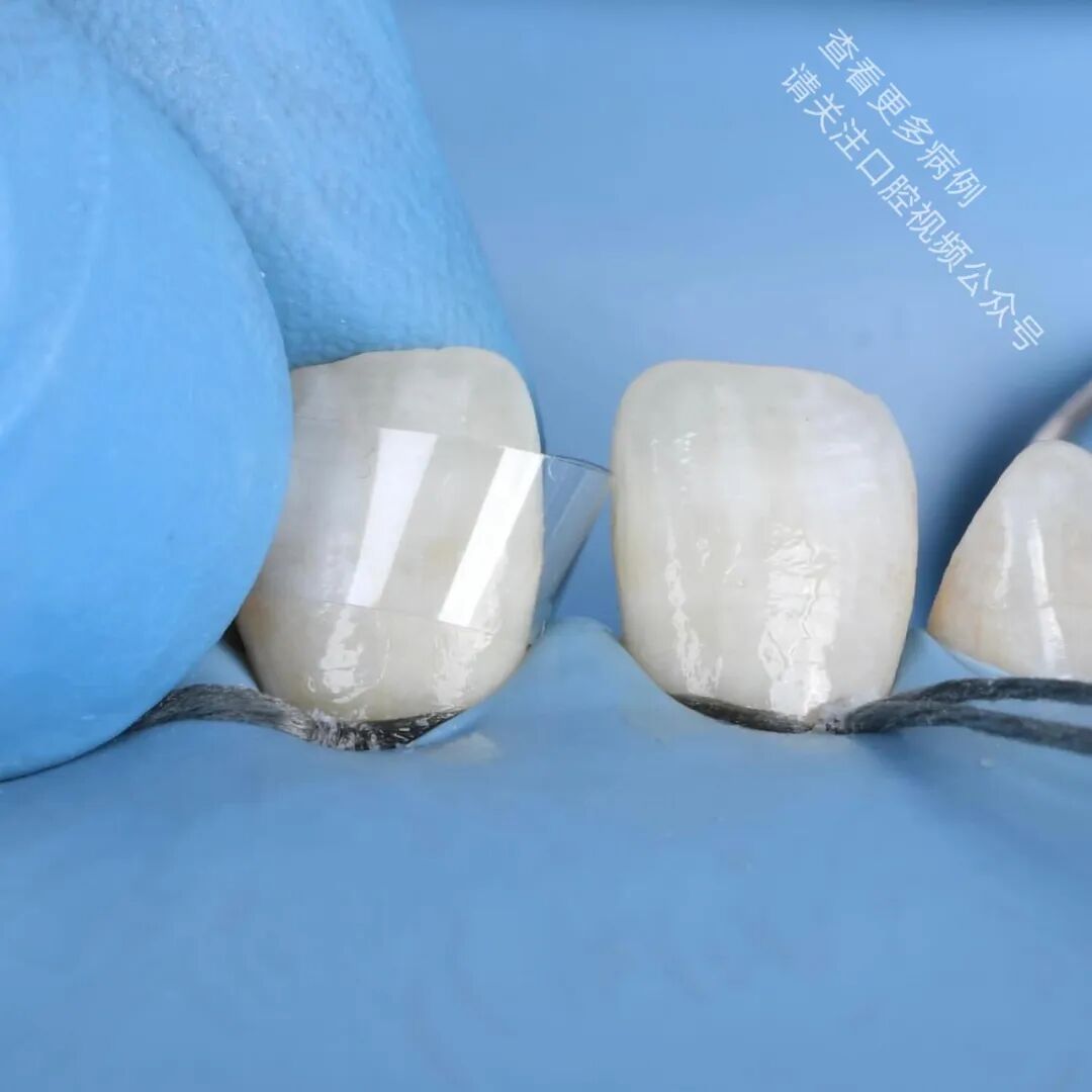 使用GC复合树脂关闭牙间隙，这16张图片讲清楚了