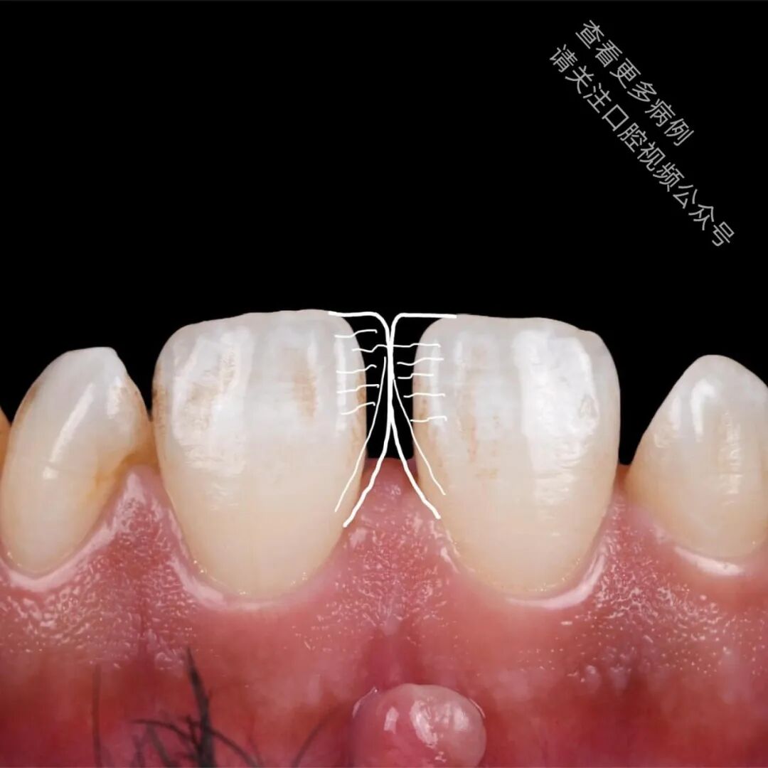 使用GC复合树脂关闭牙间隙，这16张图片讲清楚了