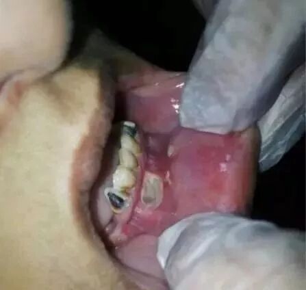 口腔冲洗液怎么喷根管冲洗使用次氯酸钠引发呼吸道阻塞，我们应该如何预防？_https://www.jmylbn.com_新闻资讯_第5张