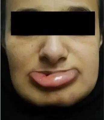 口腔冲洗液怎么喷根管冲洗使用次氯酸钠引发呼吸道阻塞，我们应该如何预防？_https://www.jmylbn.com_新闻资讯_第3张