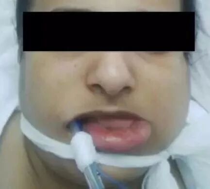 口腔冲洗液怎么喷根管冲洗使用次氯酸钠引发呼吸道阻塞，我们应该如何预防？_https://www.jmylbn.com_新闻资讯_第4张