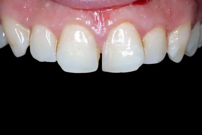 前牙间隙关闭的一种简化方法