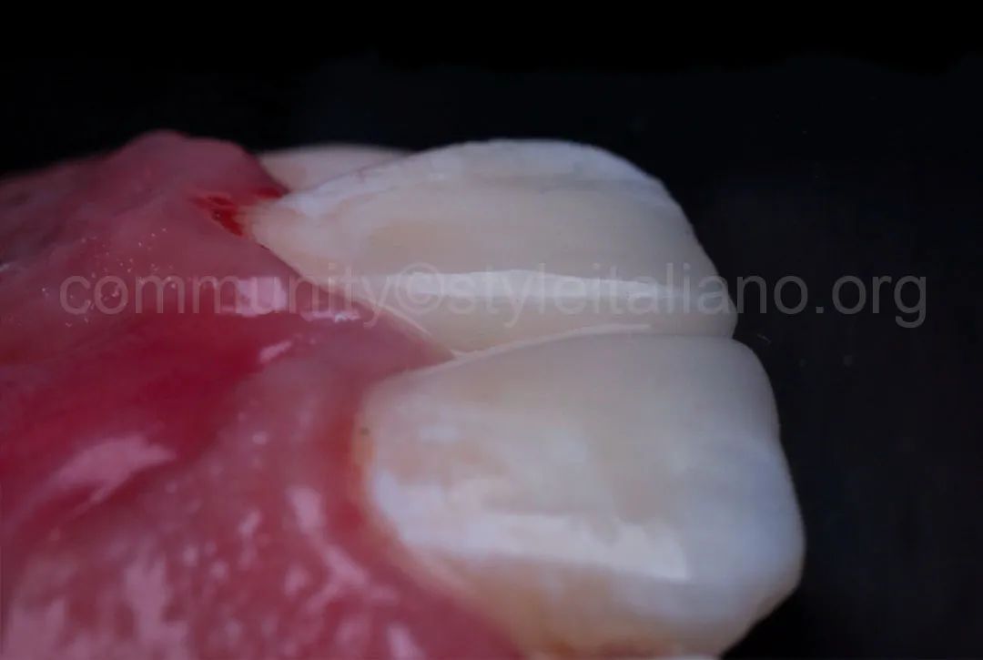 前牙间隙关闭的一种简化方法