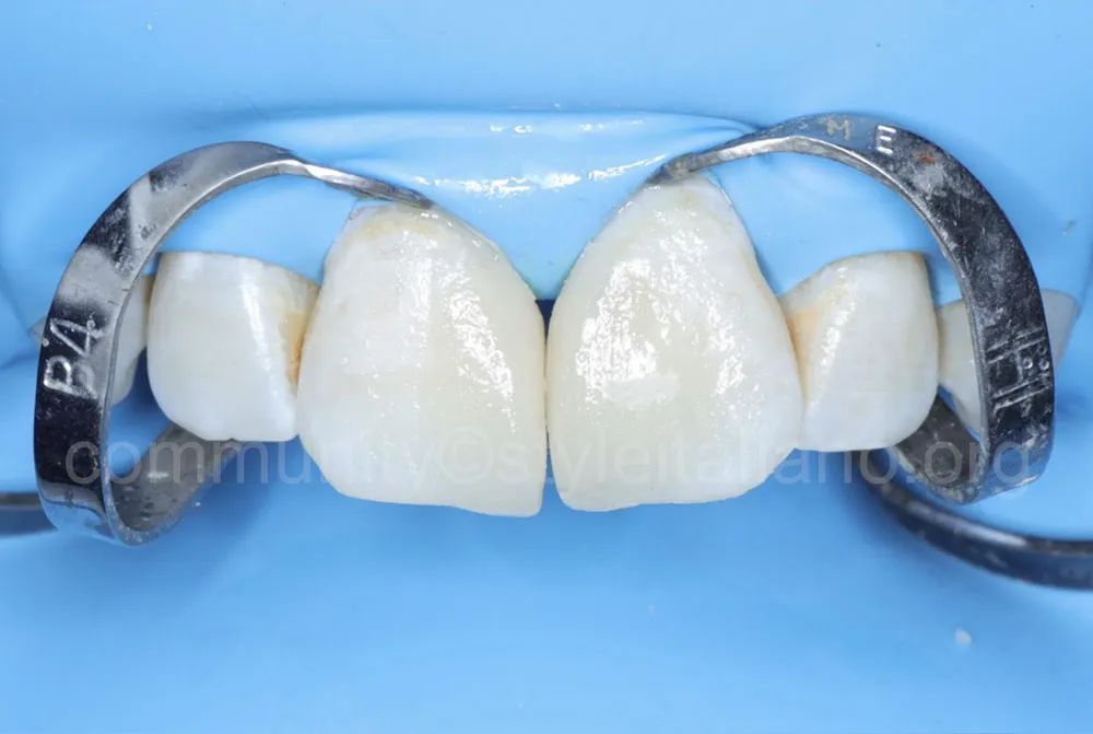 前牙间隙关闭的一种简化方法