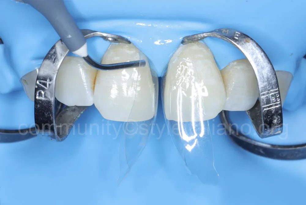 前牙间隙关闭的一种简化方法