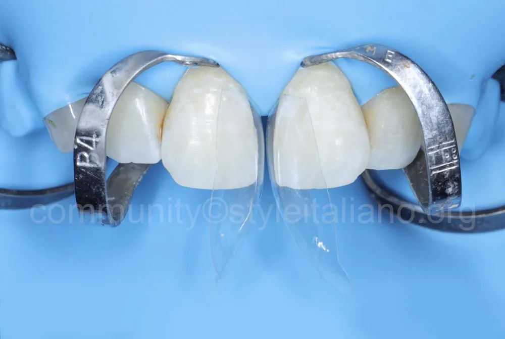 前牙间隙关闭的一种简化方法