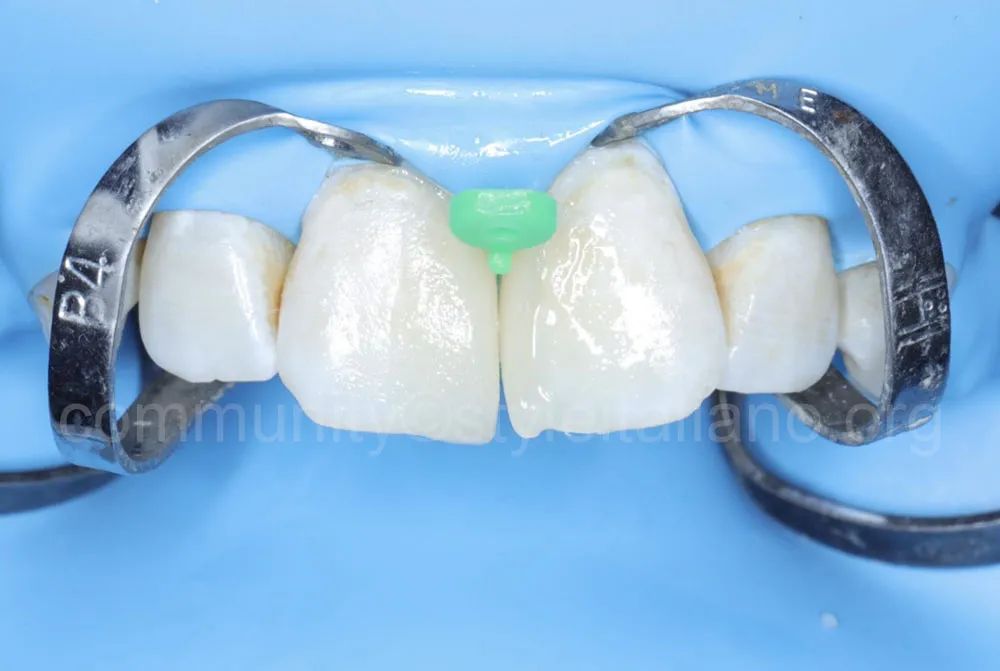 前牙间隙关闭的一种简化方法