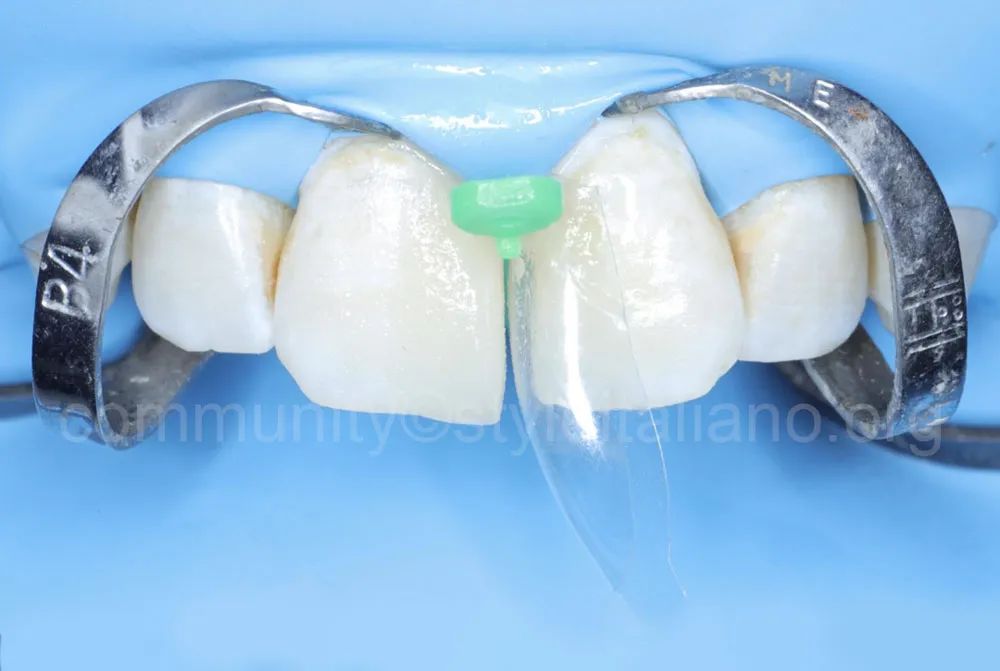 前牙间隙关闭的一种简化方法