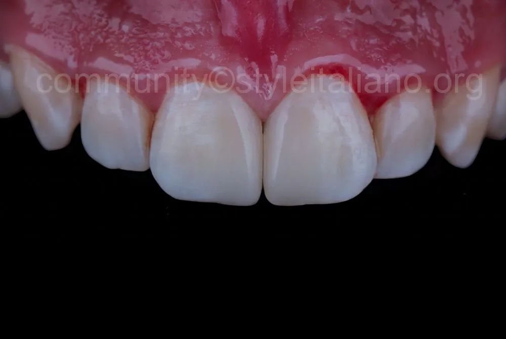 前牙间隙关闭的一种简化方法