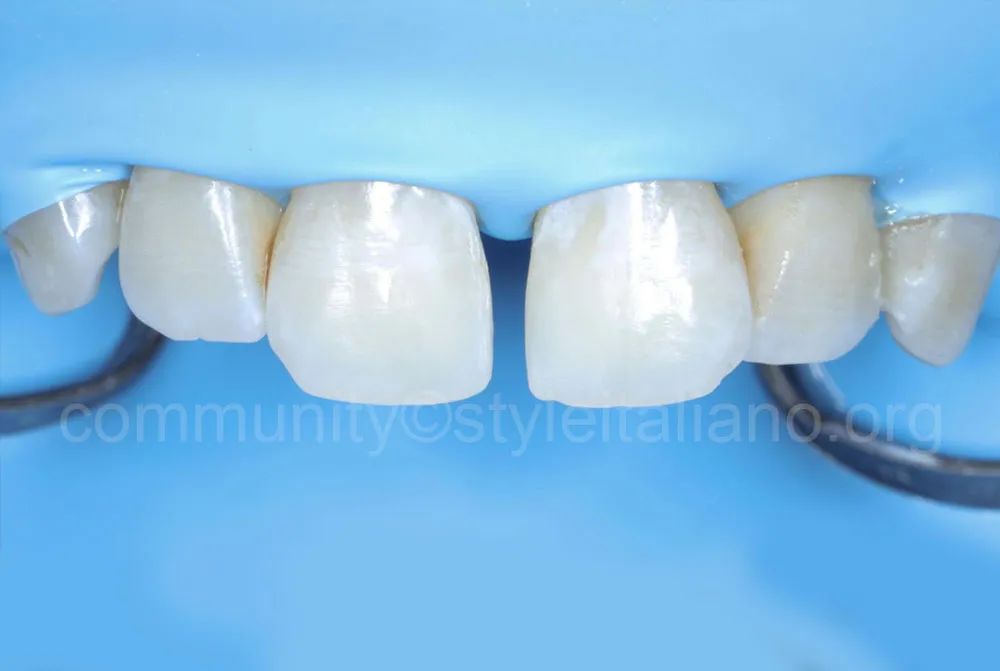 前牙间隙关闭的一种简化方法