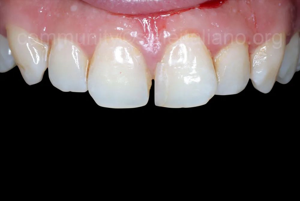 前牙间隙关闭的一种简化方法