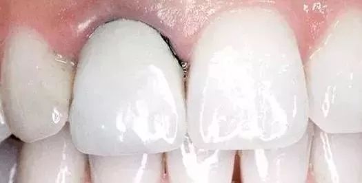 全瓷牙，让你从此摆脱牙龈黑线
