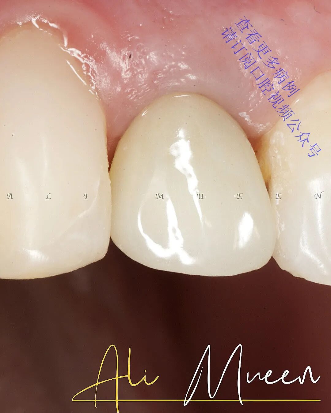 看一个利用箍效应的修复