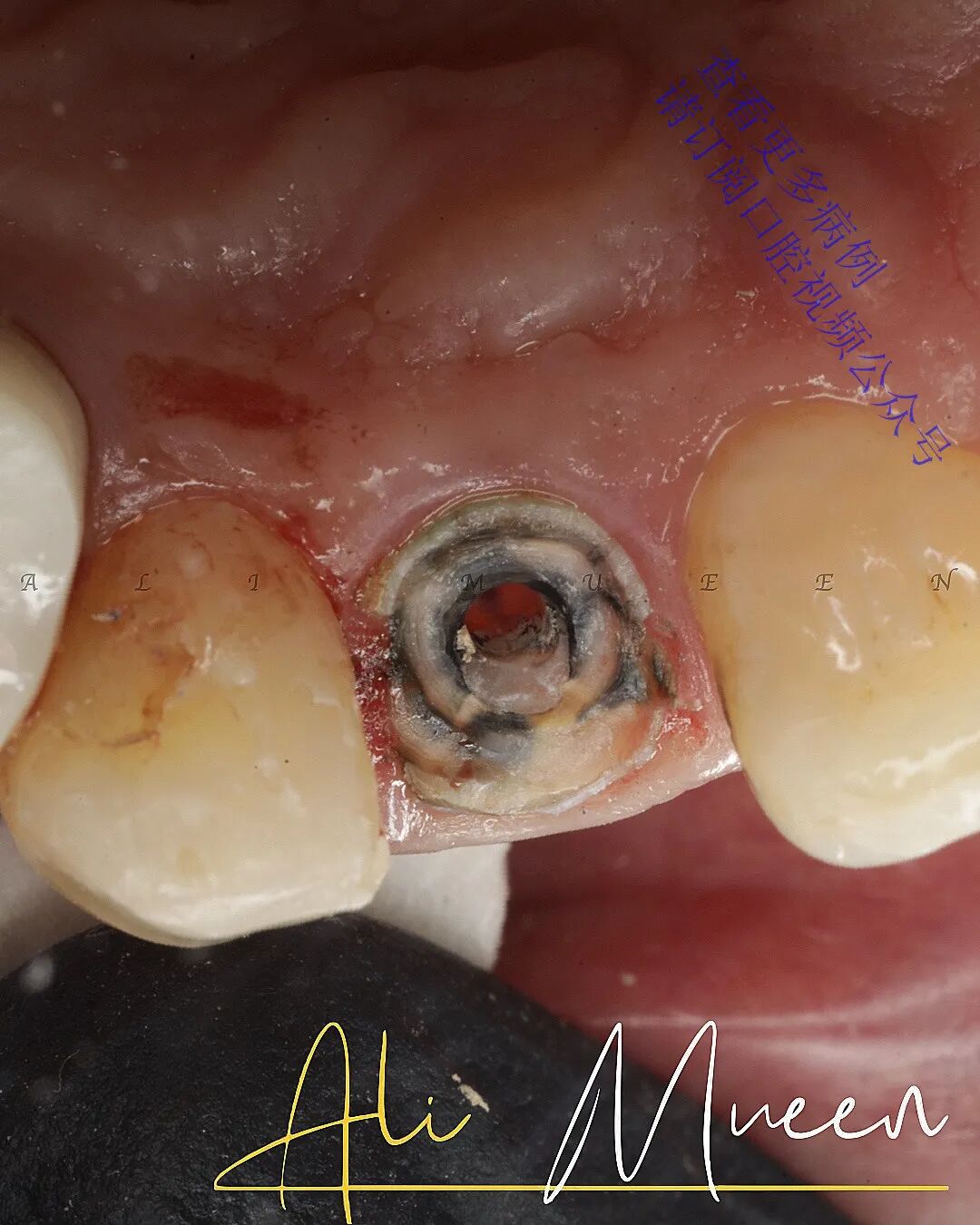 看一个利用箍效应的修复