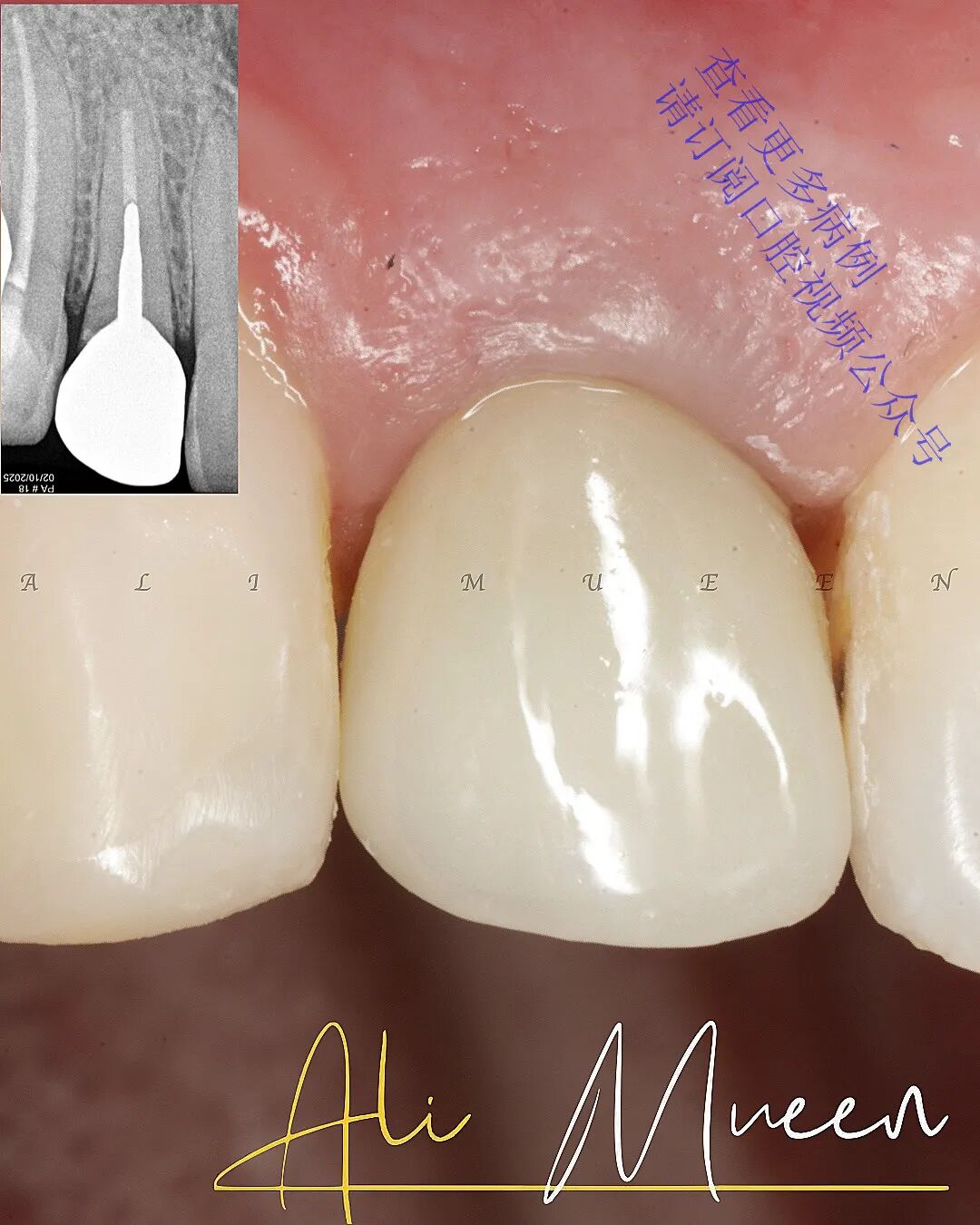 看一个利用箍效应的修复