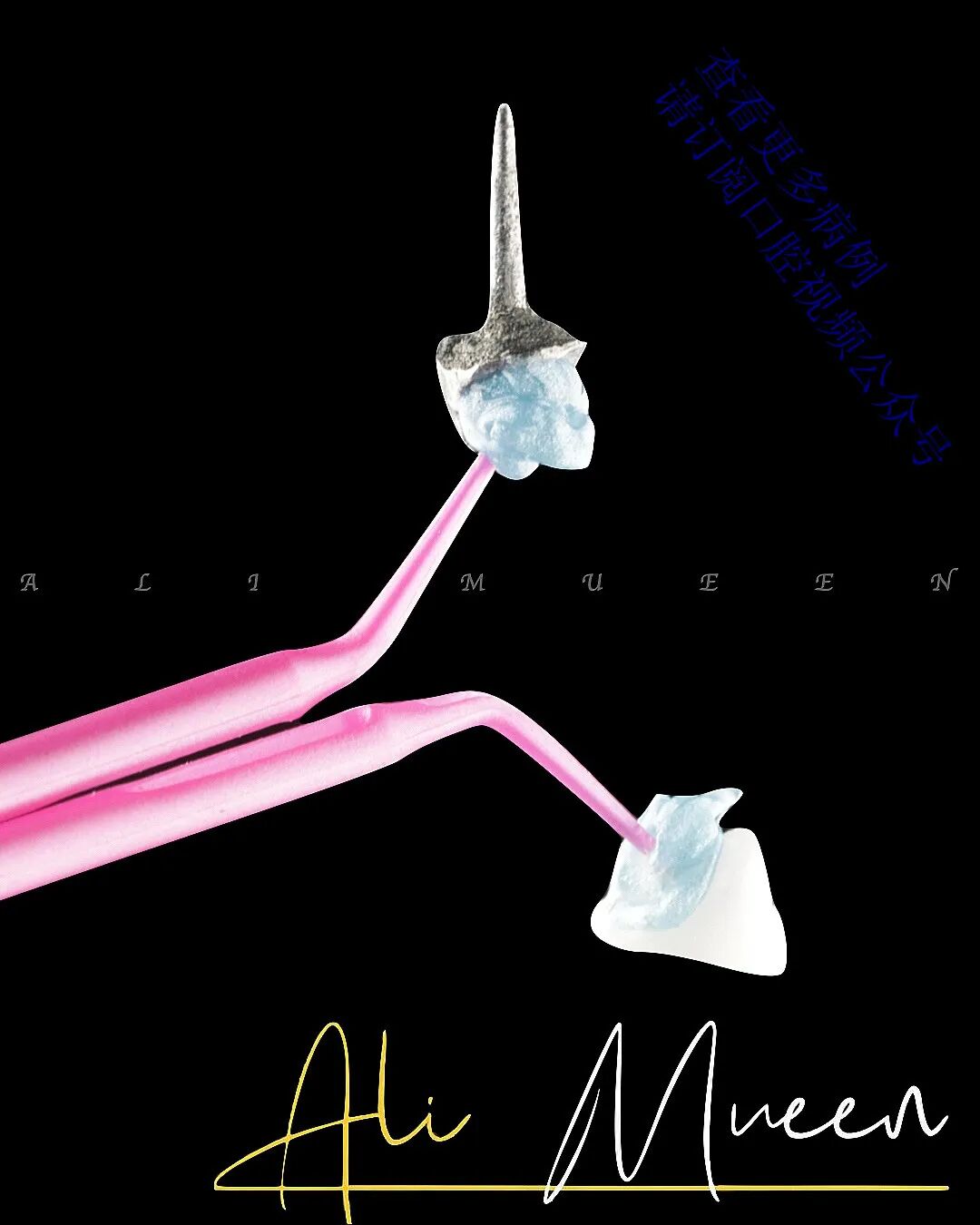 看一个利用箍效应的修复