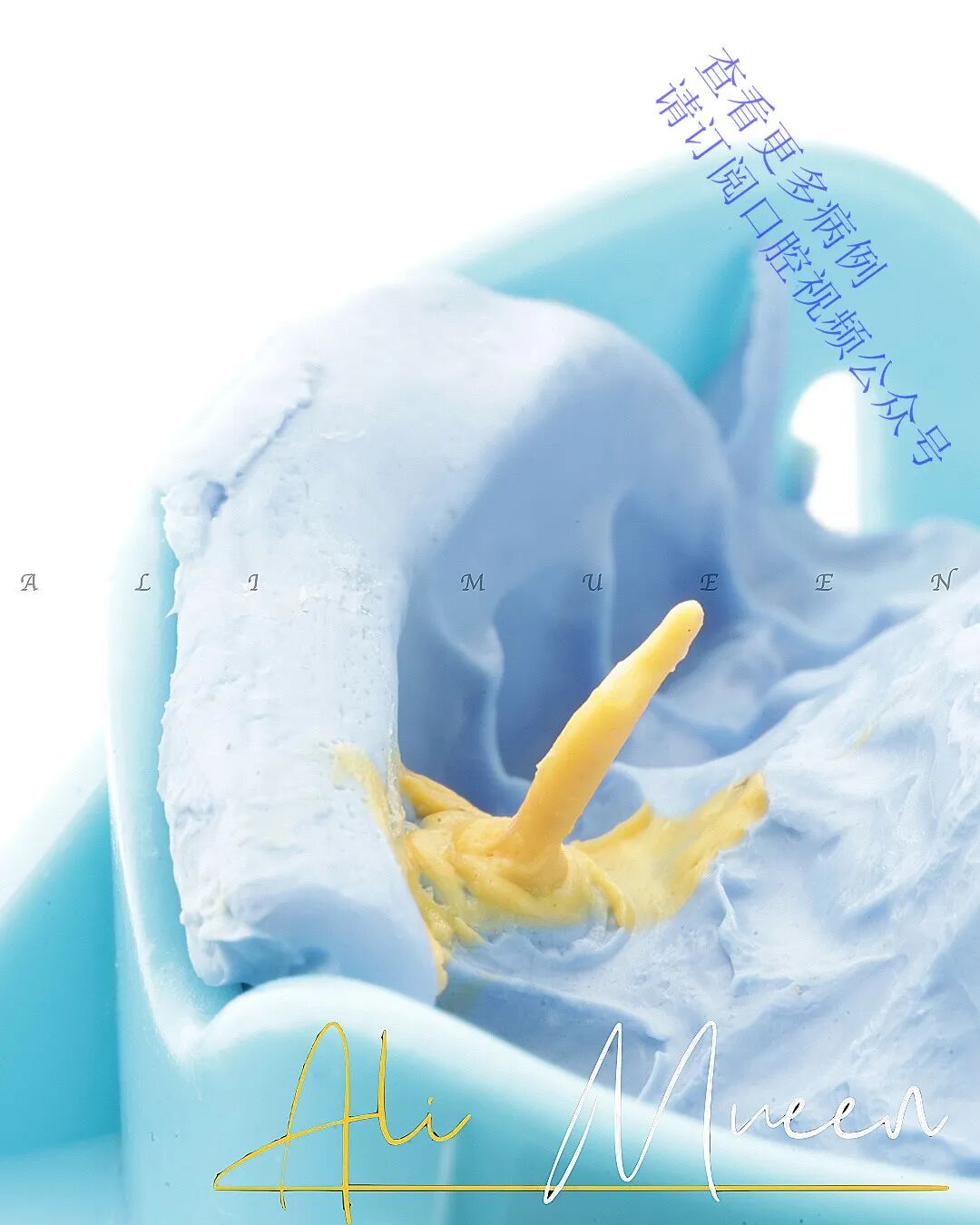 看一个利用箍效应的修复