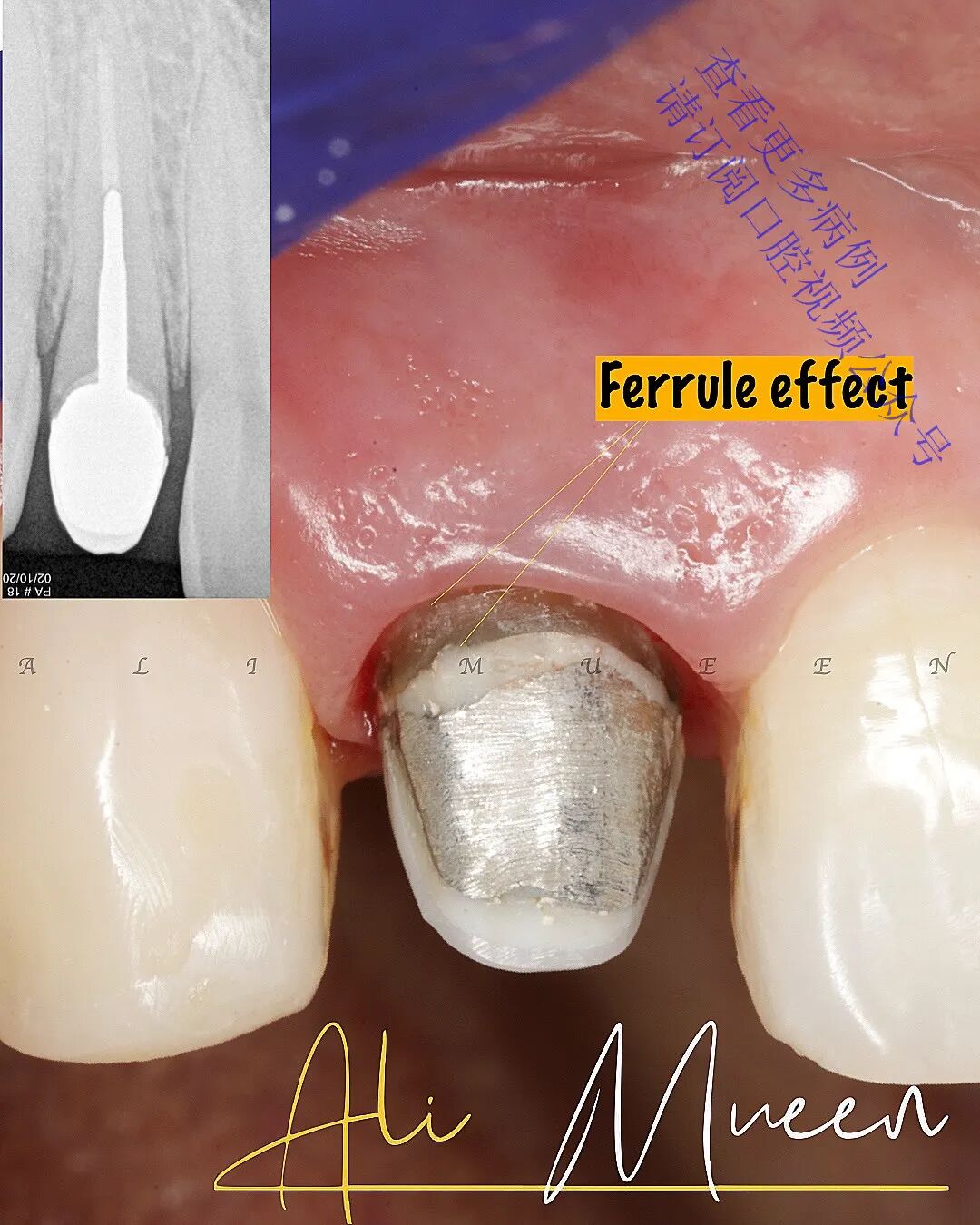 看一个利用箍效应的修复