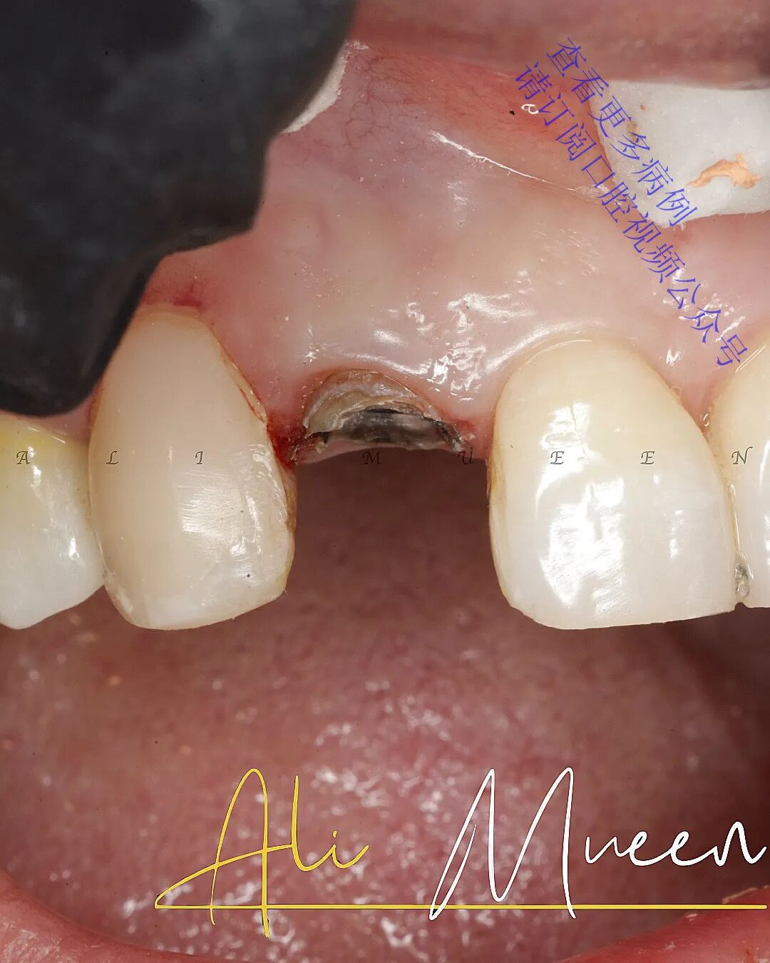 看一个利用箍效应的修复