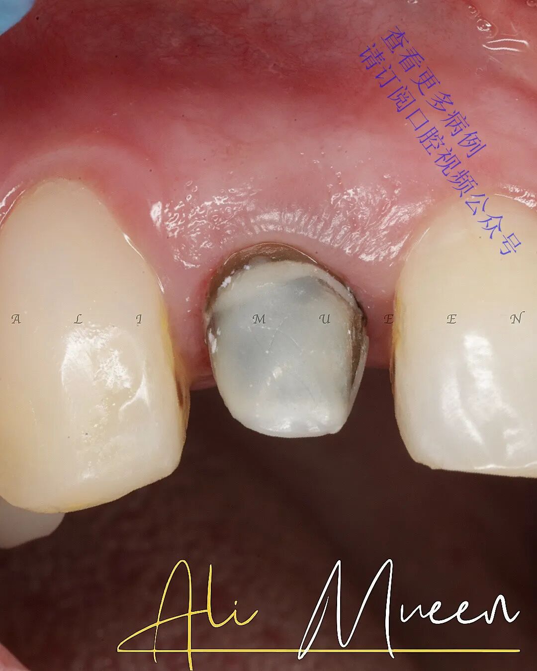 看一个利用箍效应的修复