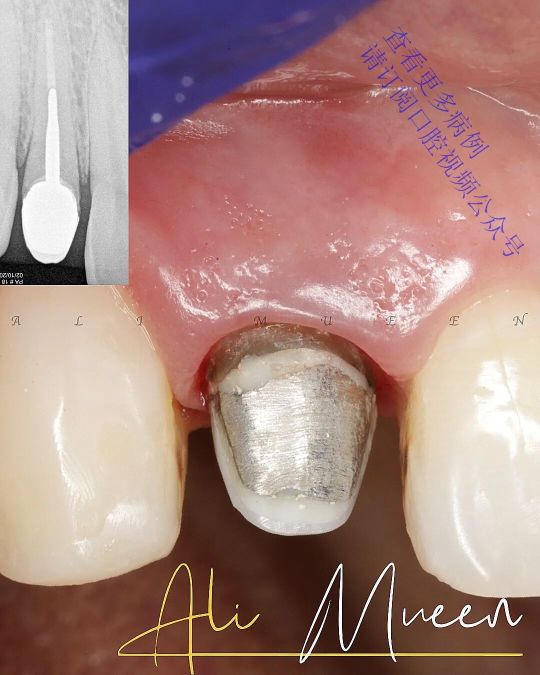 看一个利用箍效应的修复