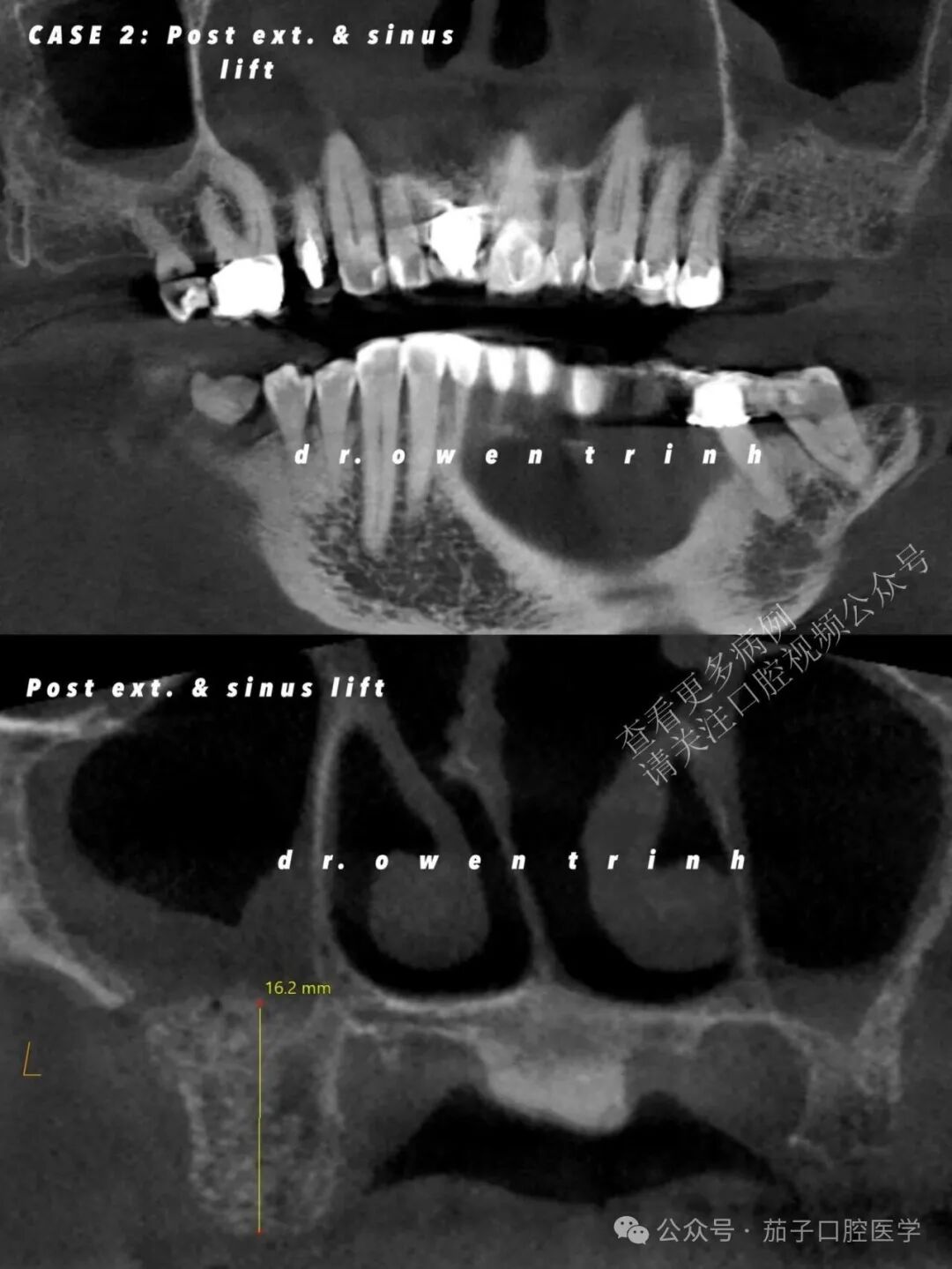 注意！根尖牙槽骨薄或脓肿，上颌窦黏膜撕裂风险高