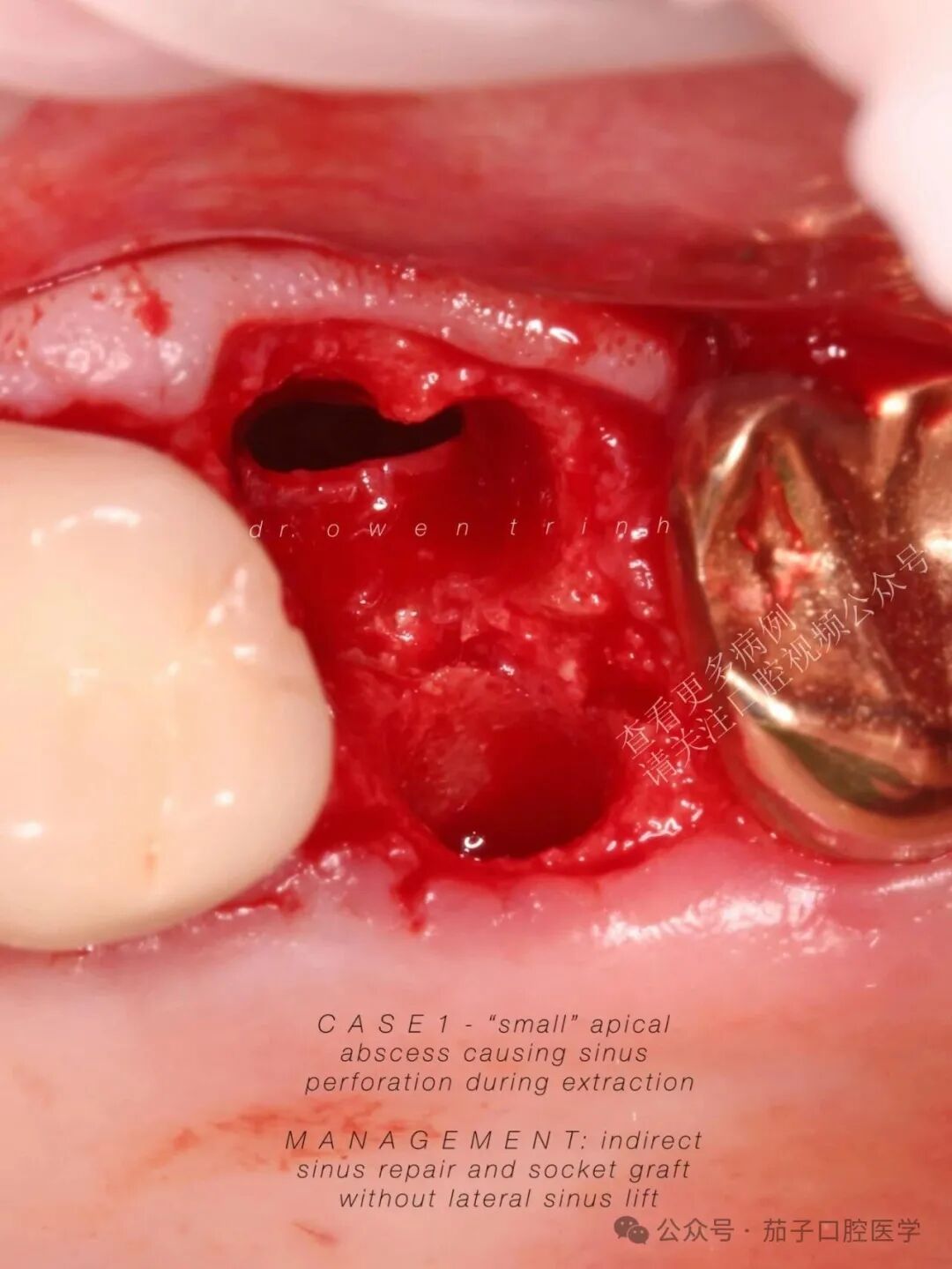 注意！根尖牙槽骨薄或脓肿，上颌窦黏膜撕裂风险高