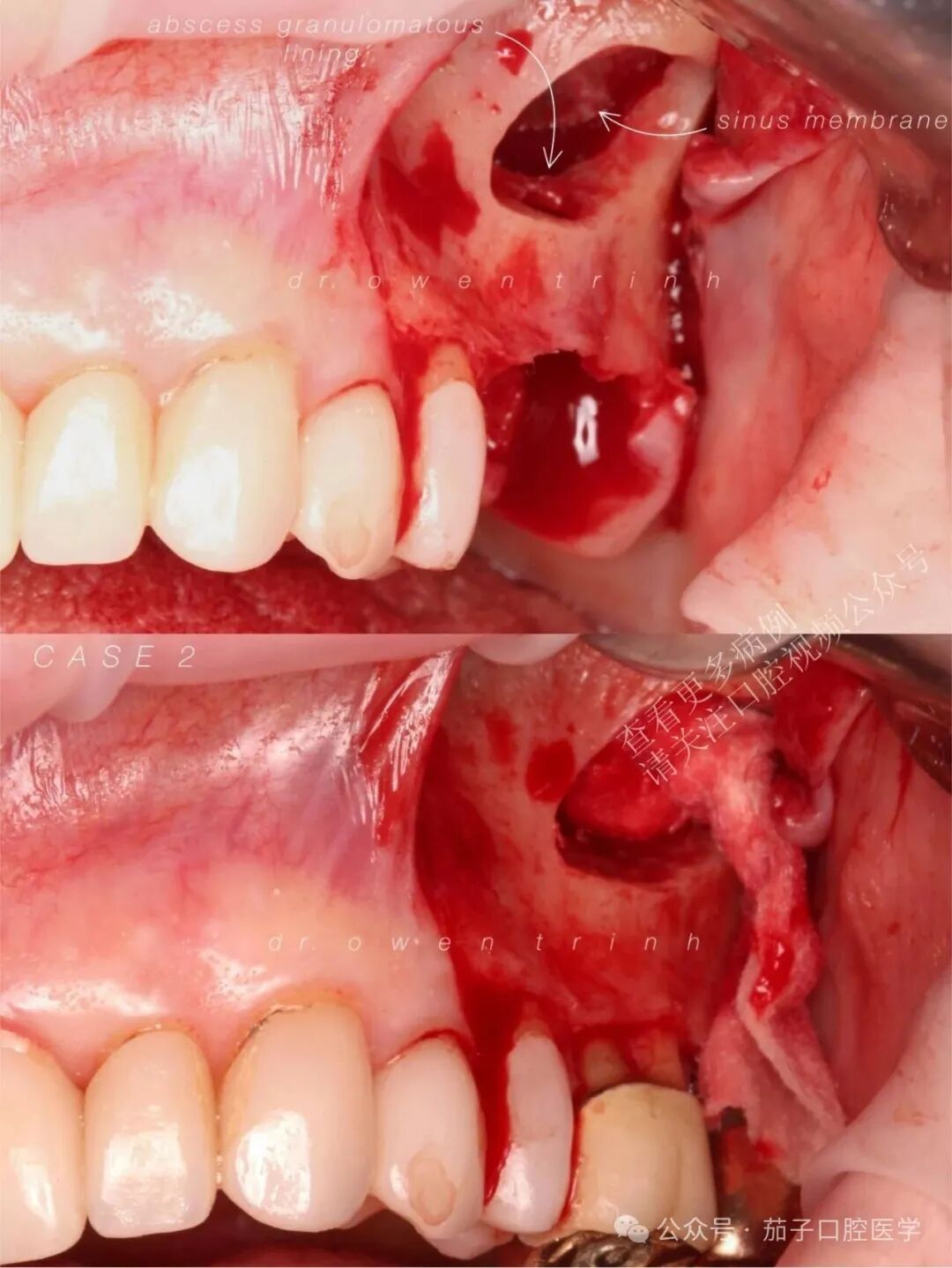 注意！根尖牙槽骨薄或脓肿，上颌窦黏膜撕裂风险高