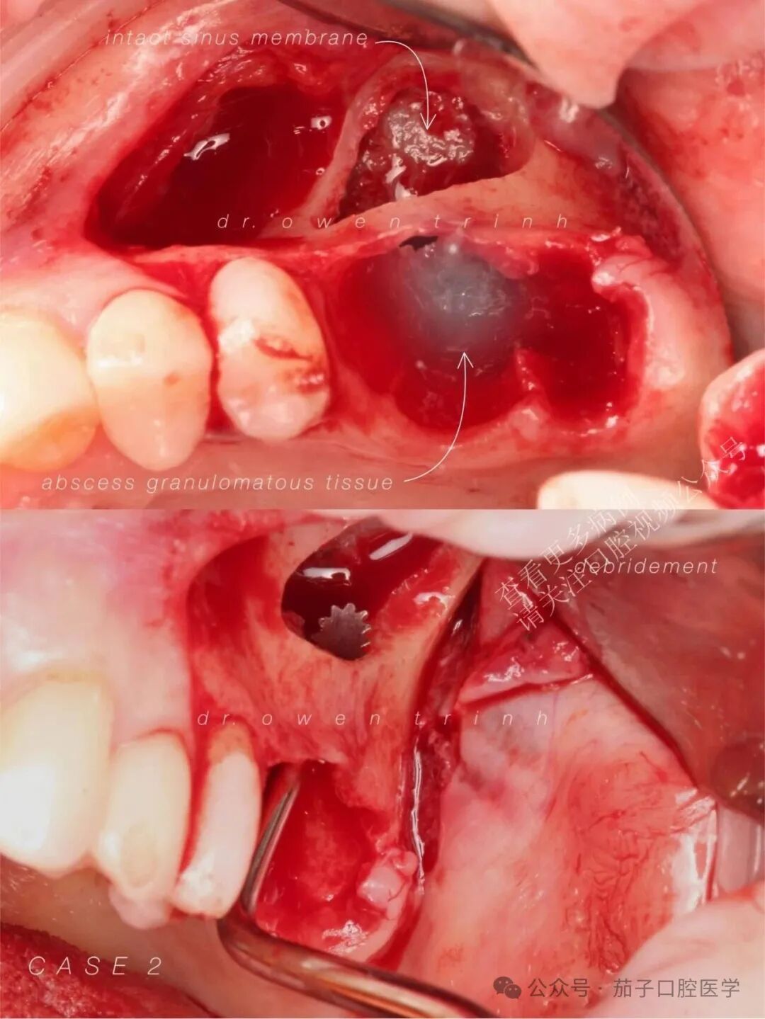 注意！根尖牙槽骨薄或脓肿，上颌窦黏膜撕裂风险高