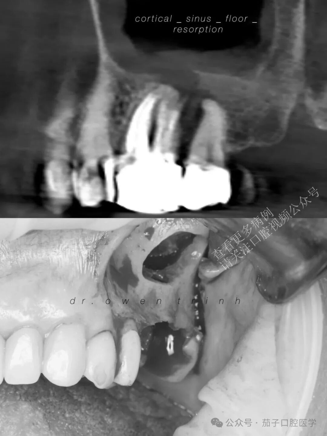 注意！根尖牙槽骨薄或脓肿，上颌窦黏膜撕裂风险高