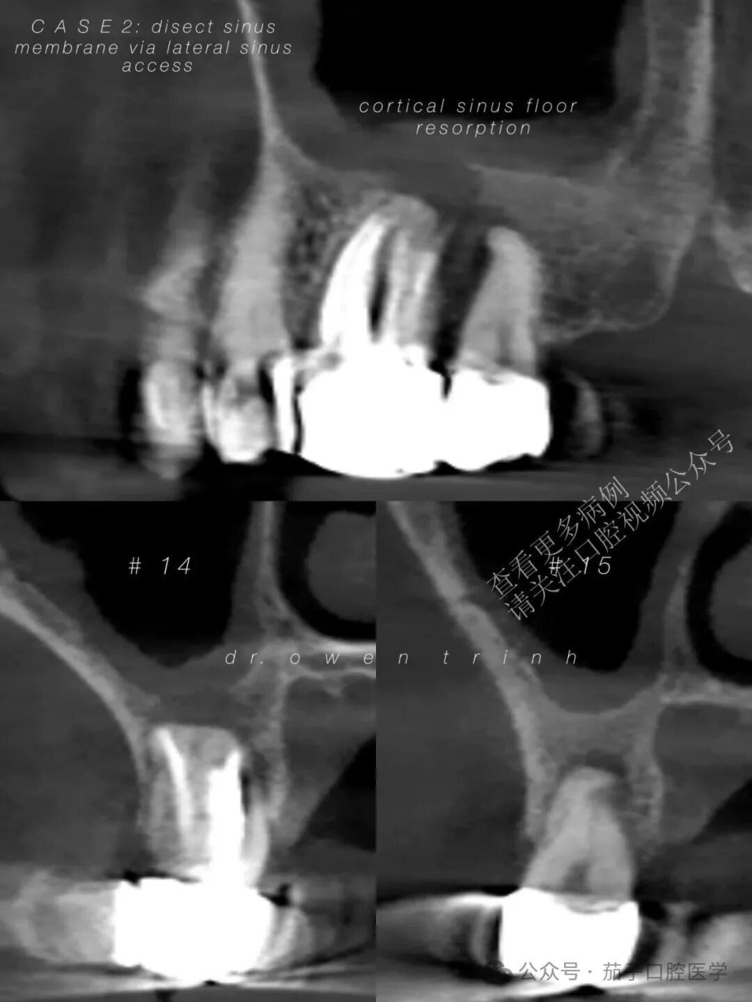 注意！根尖牙槽骨薄或脓肿，上颌窦黏膜撕裂风险高