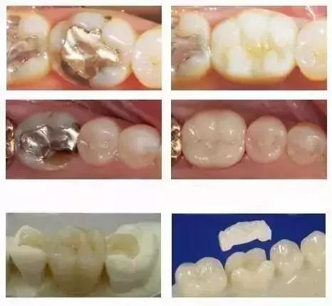 牙體修復的新寵兒——嵌體，到底厲害在哪裡？ 健康 第11張