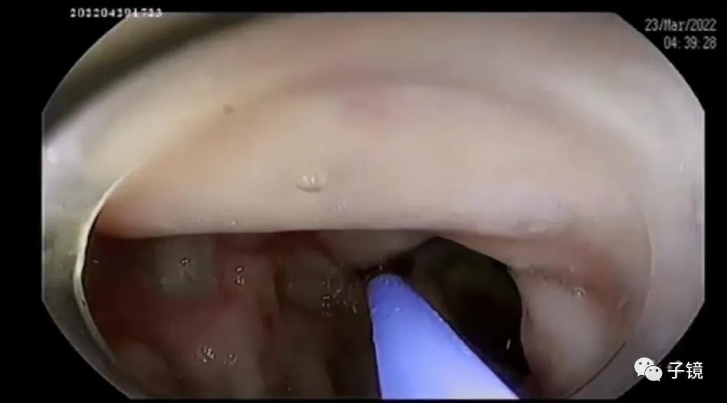 什么是电凝止血“非静脉曲张性消化道出血内镜止血宝典”学习笔记_https://www.jmylbn.com_新闻资讯_第8张