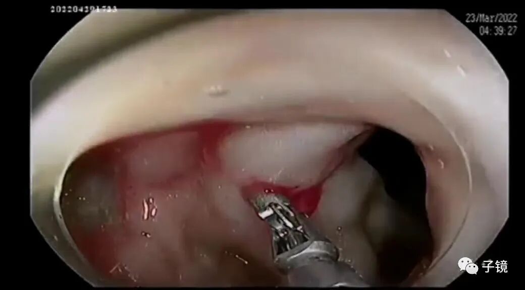 什么是电凝止血“非静脉曲张性消化道出血内镜止血宝典”学习笔记_https://www.jmylbn.com_新闻资讯_第7张