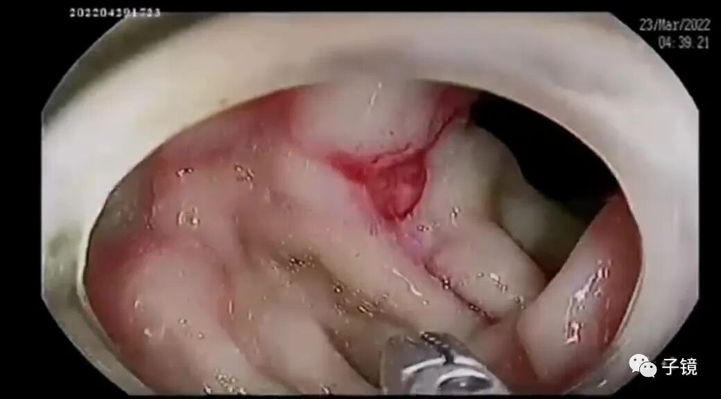 什么是电凝止血“非静脉曲张性消化道出血内镜止血宝典”学习笔记_https://www.jmylbn.com_新闻资讯_第5张