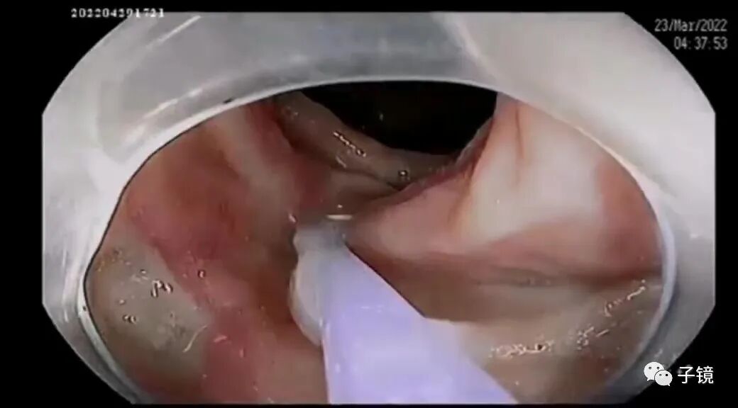 什么是电凝止血“非静脉曲张性消化道出血内镜止血宝典”学习笔记_https://www.jmylbn.com_新闻资讯_第4张