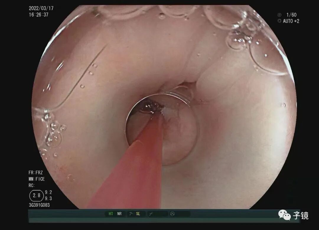 什么是电凝止血“非静脉曲张性消化道出血内镜止血宝典”学习笔记_https://www.jmylbn.com_新闻资讯_第11张