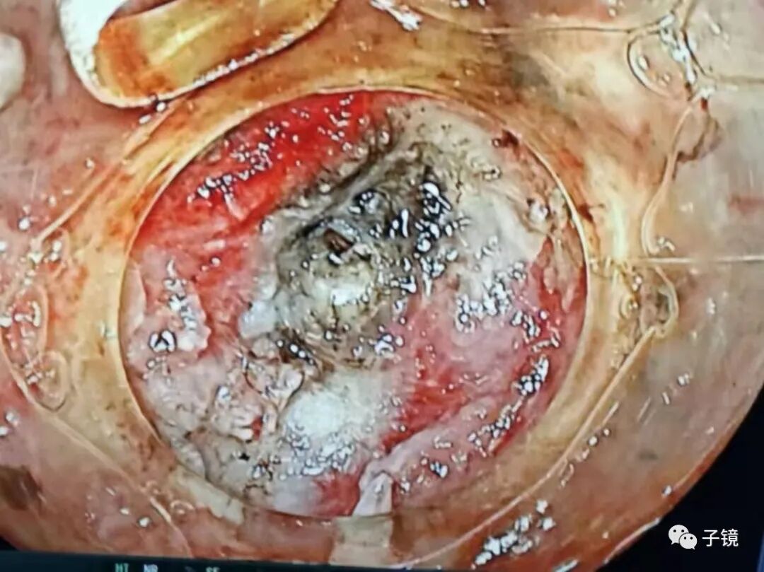 什么是电凝止血“非静脉曲张性消化道出血内镜止血宝典”学习笔记_https://www.jmylbn.com_新闻资讯_第14张