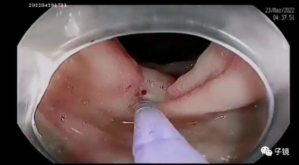 什么是电凝止血“非静脉曲张性消化道出血内镜止血宝典”学习笔记_https://www.jmylbn.com_新闻资讯_第3张