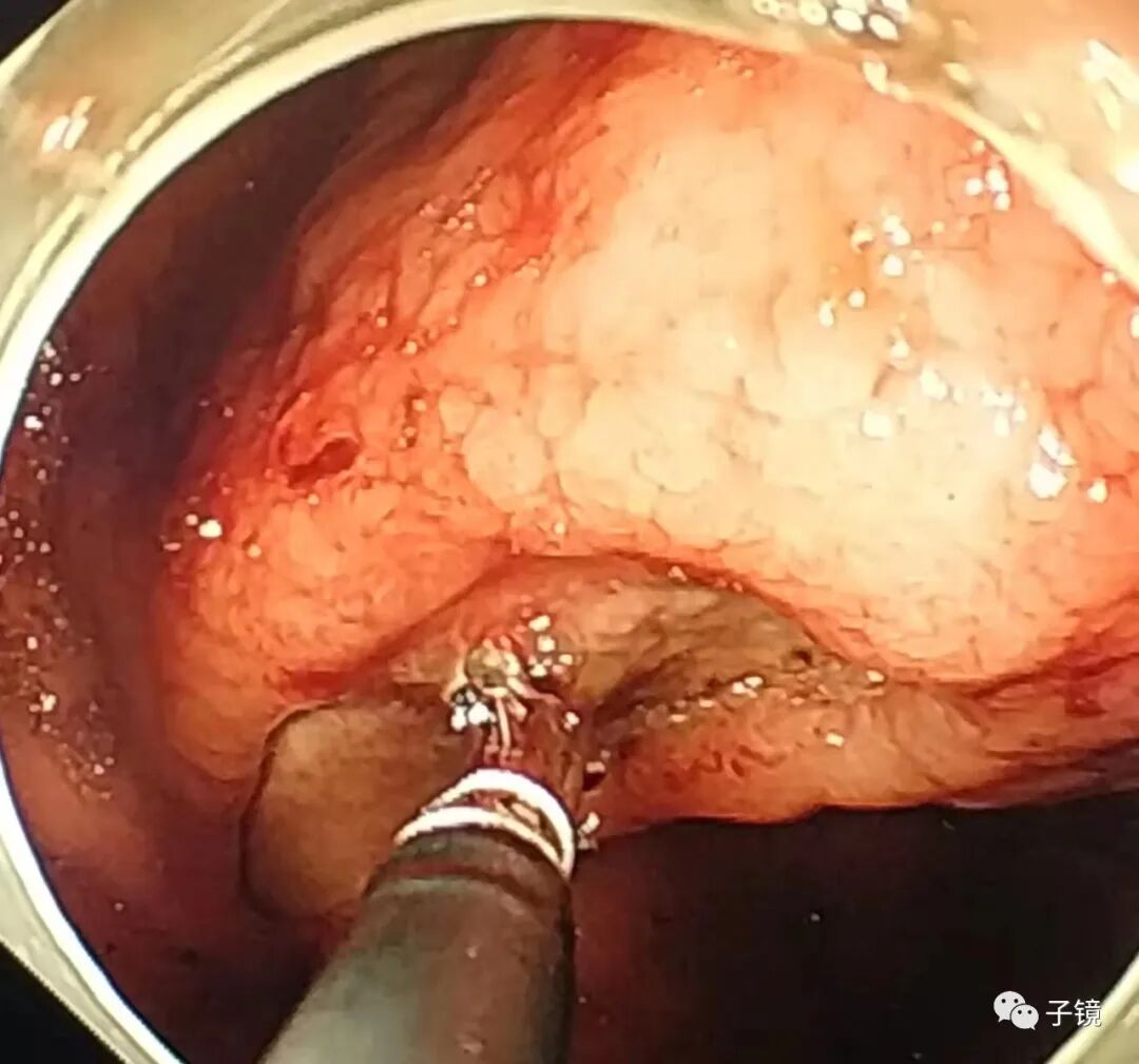 什么是电凝止血“非静脉曲张性消化道出血内镜止血宝典”学习笔记_https://www.jmylbn.com_新闻资讯_第19张